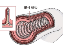 慢性肠炎治不好怎么办